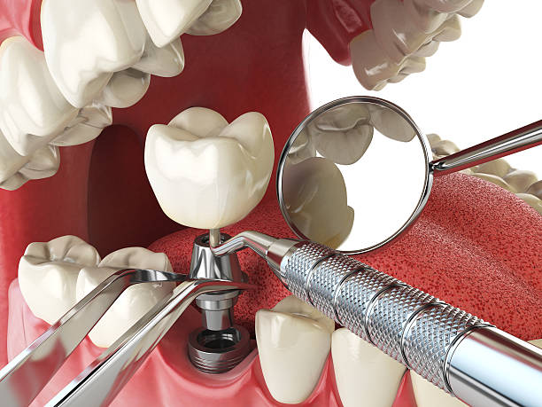 Best Emergency Dentist for Knocked-Out Tooth in Galveston, IN