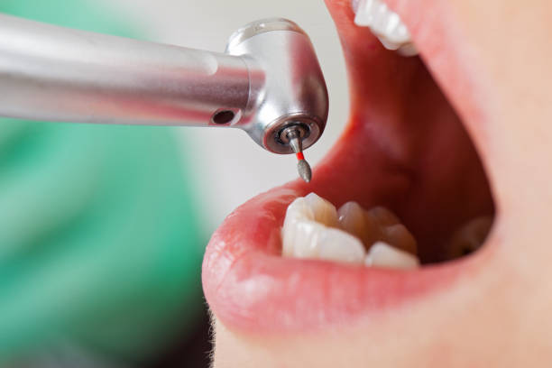 Best Emergency Dentist for Lost Fillings or Crowns in Galveston, IN